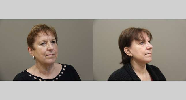 Facial Rejuvenation: Image #1116