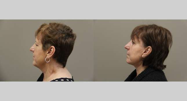 Facial Rejuvenation: Image #1117