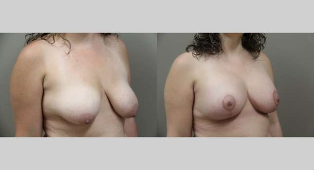 Breast Augmentation: Image #1126