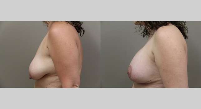 Breast Augmentation: Image #1127