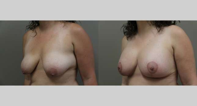 Breast Augmentation: Image #1128