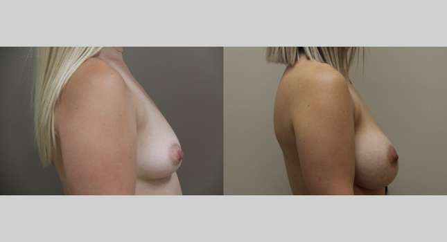 Breast Augmentation: Image #1130