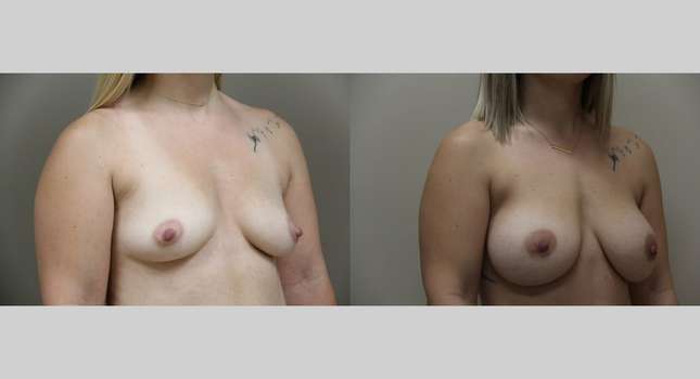 Breast Augmentation: Image #1131