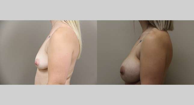Breast Augmentation: Image #1132
