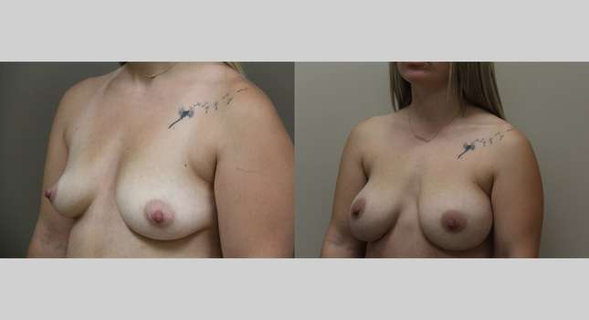 Breast Augmentation: Image #1133