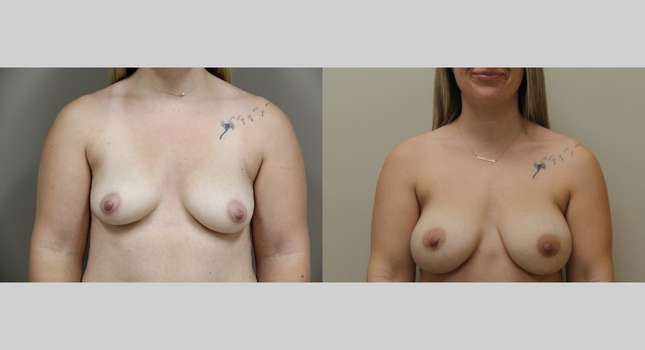 Breast Augmentation: Image #1134
