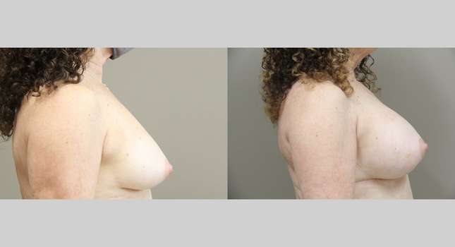 Breast Augmentation: Image #1135