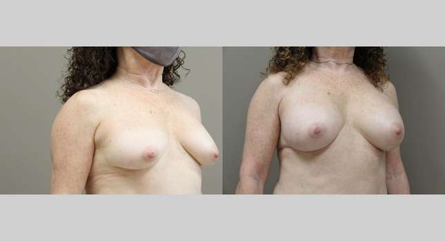 Breast Augmentation: Image #1136