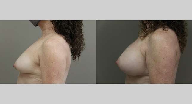 Breast Augmentation: Image #1138