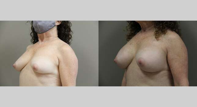 Breast Augmentation: Image #1139