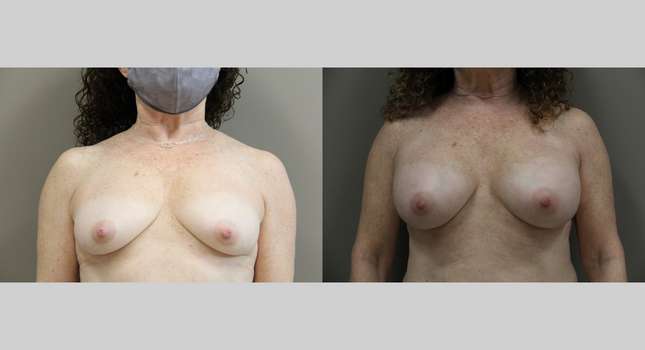 Breast Augmentation: Image #1140