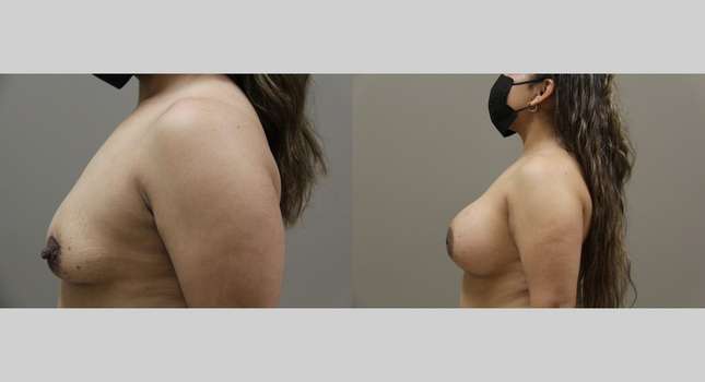 Breast Augmentation: Image #1141