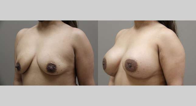 Breast Augmentation: Image #1142