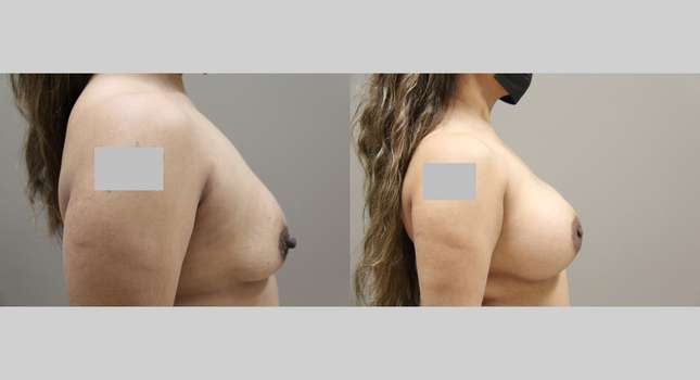 Breast Augmentation: Image #1143