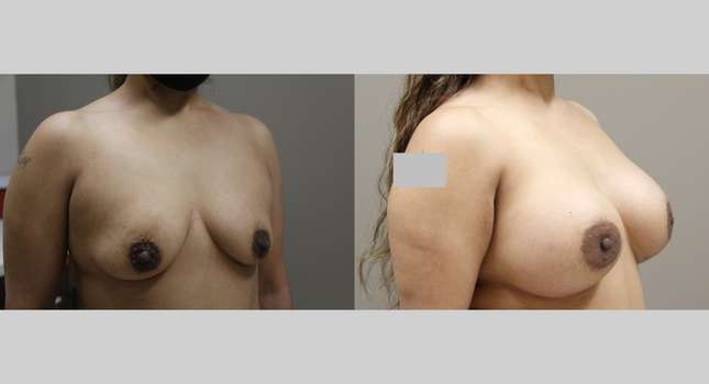 Breast Augmentation: Image #1144