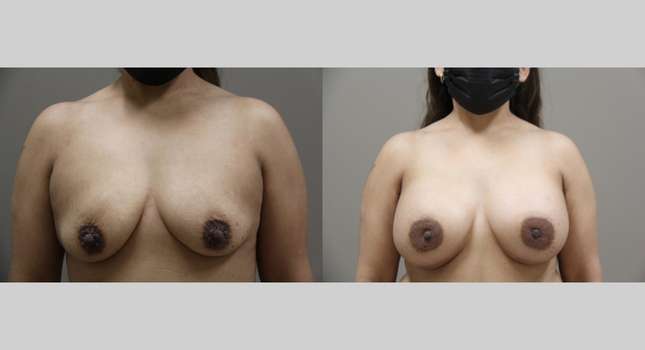 Breast Augmentation: Image #1145