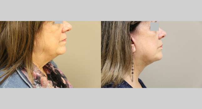 Facial Rejuvenation: Image #1165
