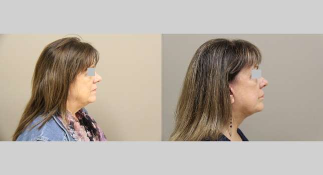 Facial Rejuvenation: Image #1166