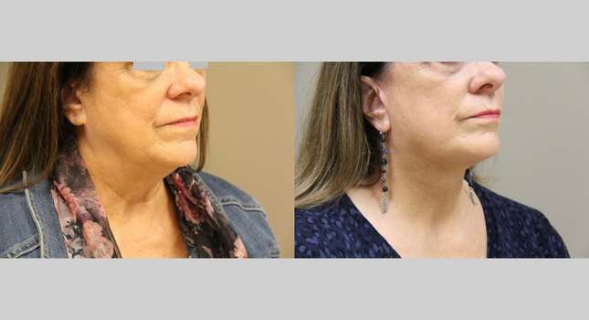 Facial Rejuvenation: Image #1167