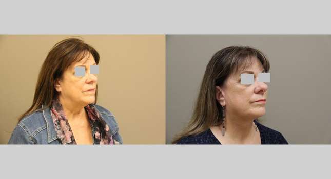 Facial Rejuvenation: Image #1168