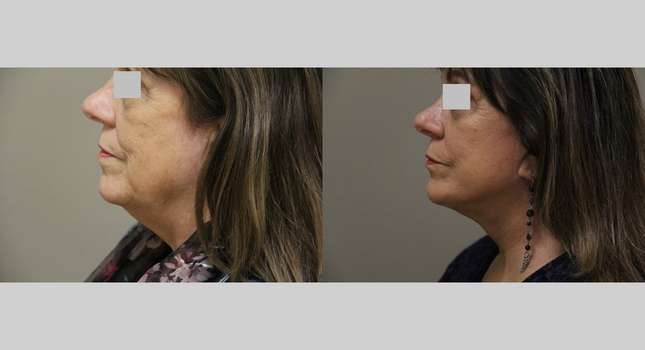 Facial Rejuvenation: Image #1169