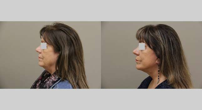 Facial Rejuvenation: Image #1170