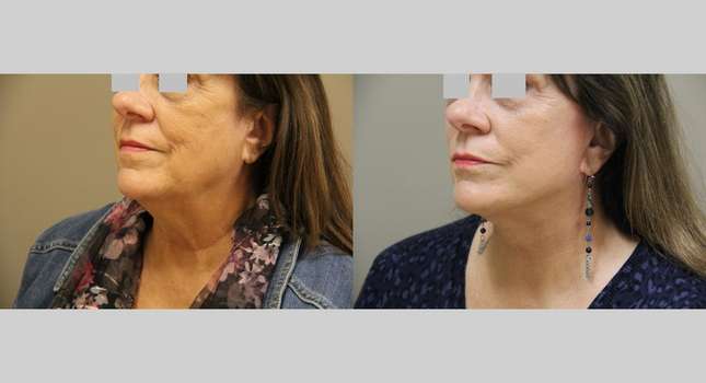 Facial Rejuvenation: Image #1171