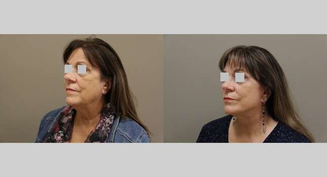 Facial Rejuvenation: Image #1172