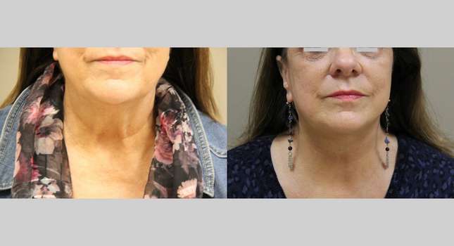 Facial Rejuvenation: Image #1173