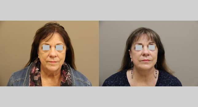 Facial Rejuvenation: Image #1174