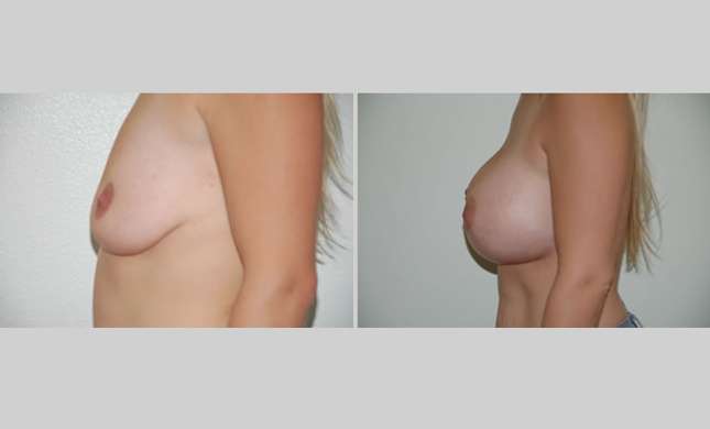 Breast Augmentation: Image #12