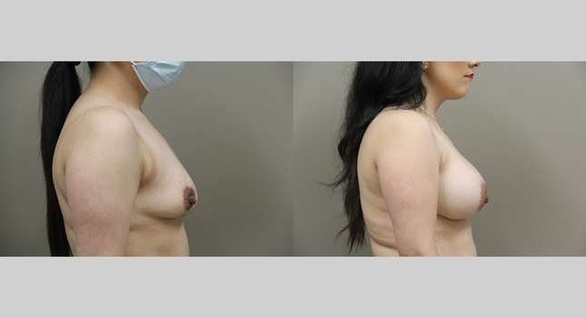 Breast Augmentation: Image #1215