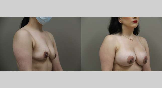 Breast Augmentation: Image #1216