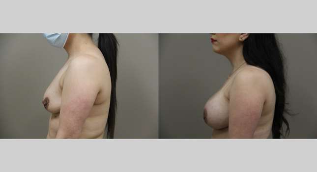 Breast Augmentation: Image #1217