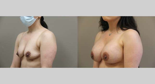 Breast Augmentation: Image #1218