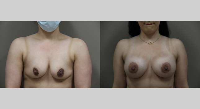 Breast Augmentation: Image #1219