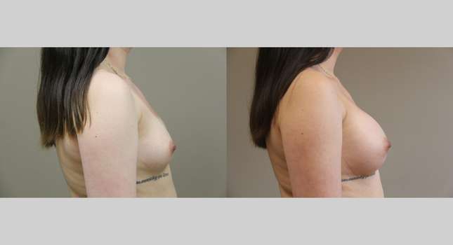 Breast Augmentation: Image #1280