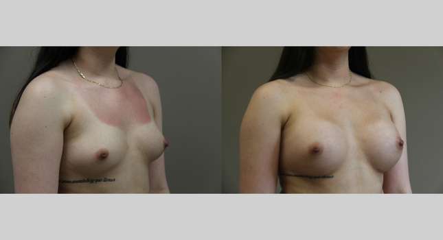 Breast Augmentation: Image #1281