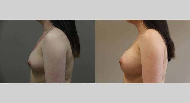 Breast Augmentation: Image #1282