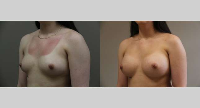 Breast Augmentation: Image #1284