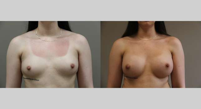 Breast Augmentation: Image #1285