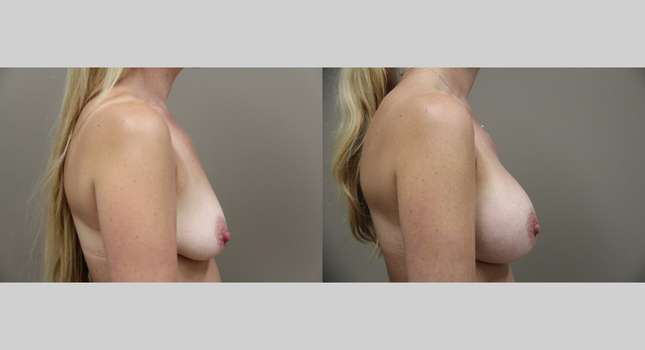 Breast Augmentation: Image #1291