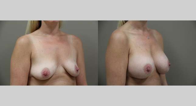 Breast Augmentation: Image #1292