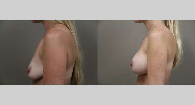 Breast Augmentation: Image #1293