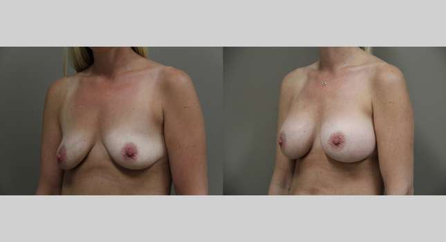 Breast Augmentation: Image #1294