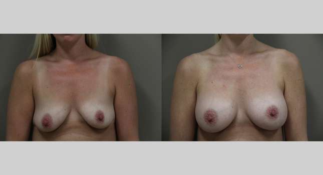 Breast Augmentation: Image #1295