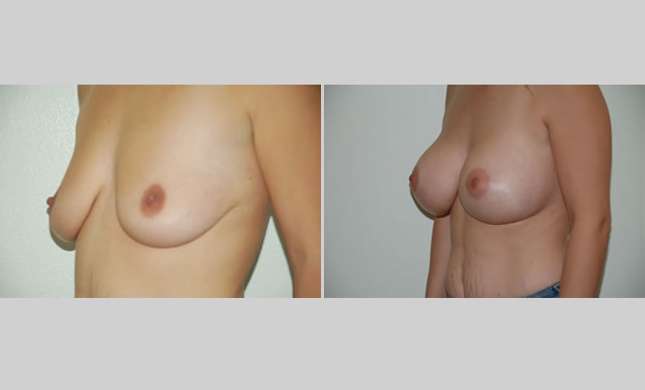Breast Augmentation: Image #13
