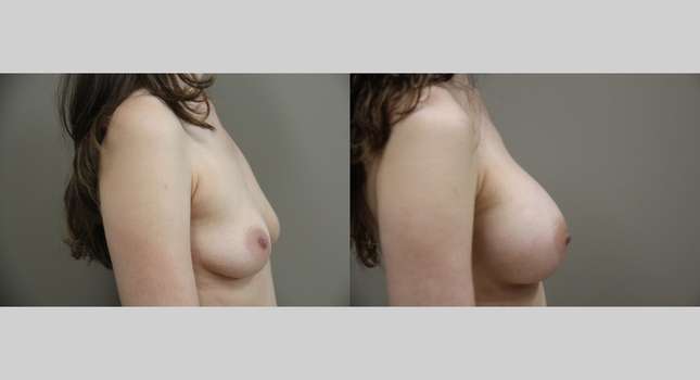 Breast Augmentation: Image #1312