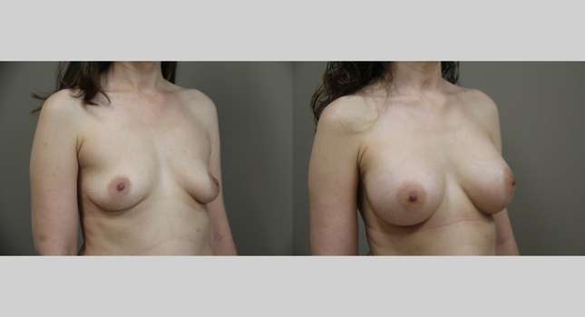 Breast Augmentation: Image #1313