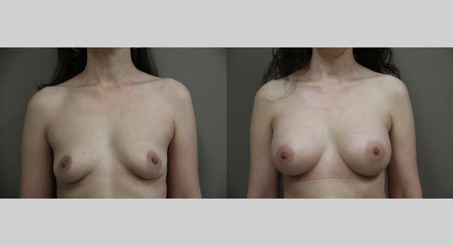 Breast Augmentation: Image #1316